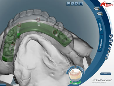 NobelProcea CAD software for prosthetic design